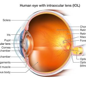 iol-lens