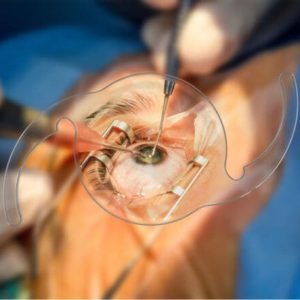 iol-surg